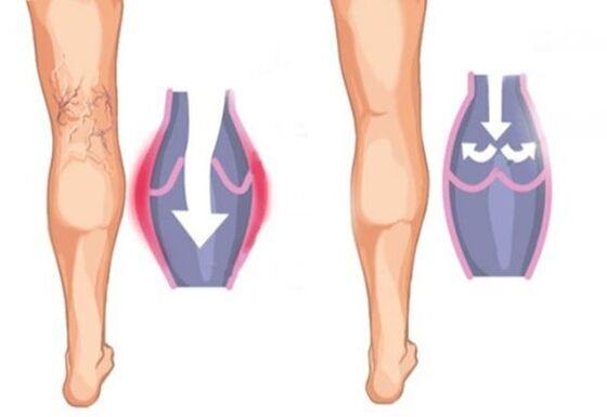 как выглядит варикозное расширение вен